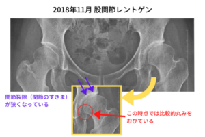 2018年11月股関節レントゲン