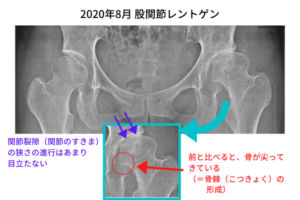 2020年8月股関節レントゲン